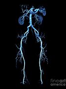 Image result for CT Angiogram Abdomen