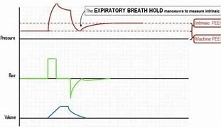 Image result for Peep COPD