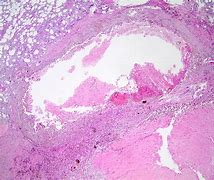 Image result for Necrosis Histology