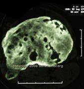 Image result for Hemangioma Tumor