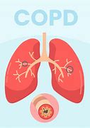 Image result for COPD Pinterest