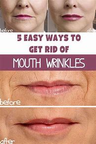 Image result for How to Remove Wrinkles around Mouth