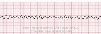 Image result for V-fib Heart Strip