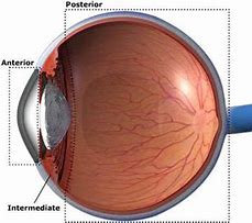 Image result for Uveitis Vision