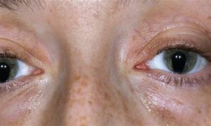 Image result for Cat Eye Syndrome