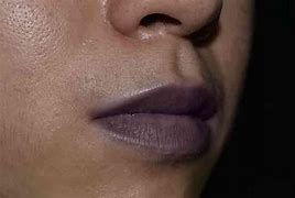 Image result for Cyanosis in Adults