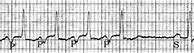 Image result for Permanent Junction Al Reciprocating Tachycardia