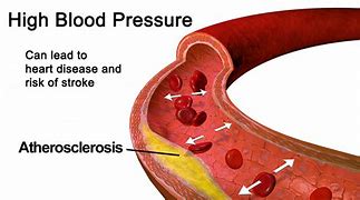 Image result for High Blood Pressure Cardiovascular Disease