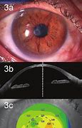 Image result for Corneal Perforation