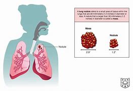 Image result for Multiple Lung Nodules