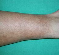 Image result for Skin Darkening Legs