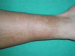 Image result for Thickened Skin On Lower Legs