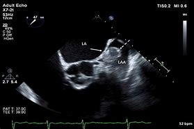 Image result for Cardiac CT Left Atrial Appendage Thrombus