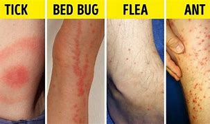 Image result for Different Bug Bites