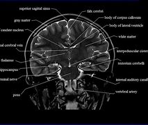 Image result for Coronal Plane Brain MRI