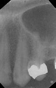 Image result for Maxillary Canine Pulp