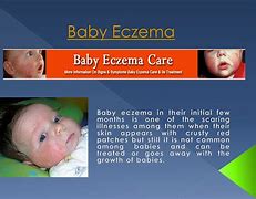 Image result for Baby Eczema Hands