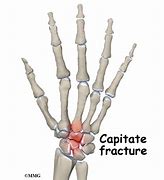 Image result for Capitate Bone Fracture