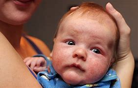 Image result for Free Pictures of Baby with Eczema