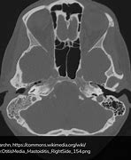 Image result for Mastoiditis