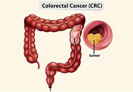 Image result for Adenocarcinoma Rectal Cancer