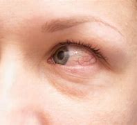 Image result for Allergic Conjunctivitis Treatment