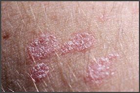 Image result for Groin Eczema Treatment