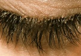 Image result for Eyelash Mite Removal