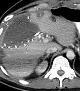 Image result for Biloma Ultrasound Images Post-Cholecystectomy