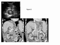 Image result for IVC Thrombs Post-Mortem