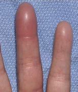 Image result for Volar Aspect Finger