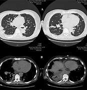 Image result for Multiple Lung Nodules