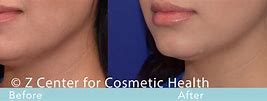 Image result for CoolSculpting Chin Before and After