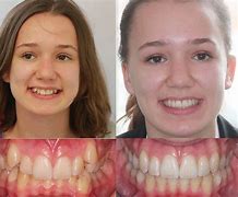 Image result for Fixed Braces Teeth Side View