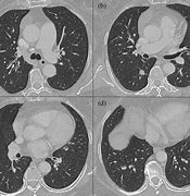 Image result for Multiple Lung Nodules