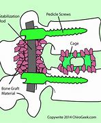 Image result for Lumbosacral Fusion