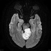 Image result for Shh Pathway Medulloblastoma