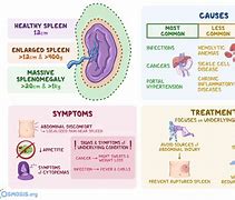 Image result for Spleen Disease Symptoms