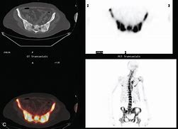 Image result for Bone Metastases