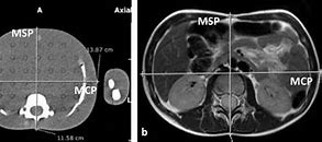 Image result for Mid Coronal Plane