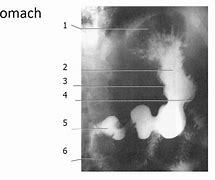 Image result for Stomach in X-ray