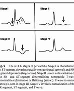 Image result for Acute Endocarditis