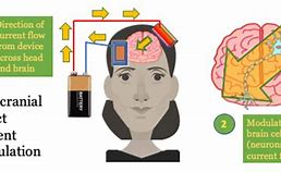 Image result for What Is a tDCS