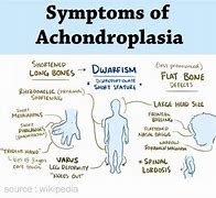 Image result for Achondroplasia X-ray