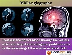 Image result for Brain MRI Angiogram