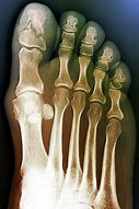 Image result for Broken Toe Bone