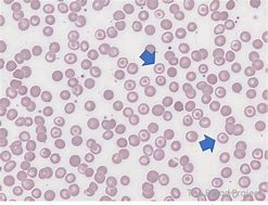 Image result for Target Cells RBC