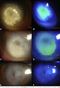 Image result for Corneal Perforation