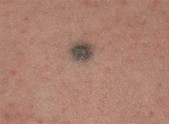 Image result for Black Spots On Skin Means