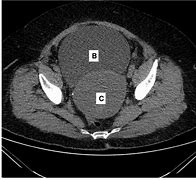 Image result for Distended Bladder